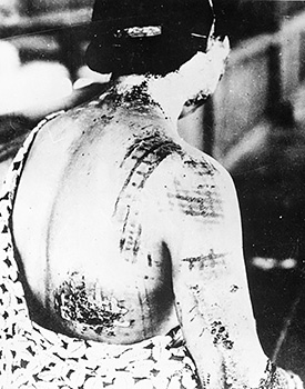 A Japanese woman who was an atomic bomb burn victim