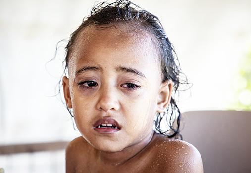 A child with measles