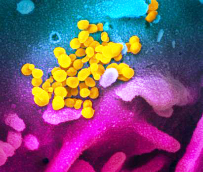 electron microscope image of SARS-CoV-2