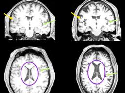 brain images of older person and younger person