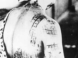 A Japanese woman who was an atomic bomb burn victim