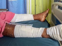 Man with legs bandaged from pig attack