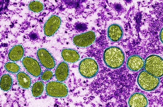 monkeypox virus, shown here in a colored electron micrograph
