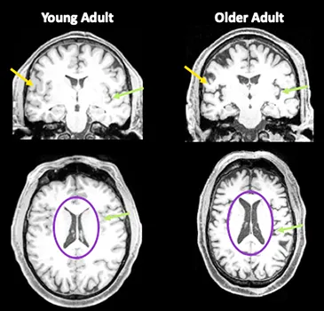 brain images of older person and younger person