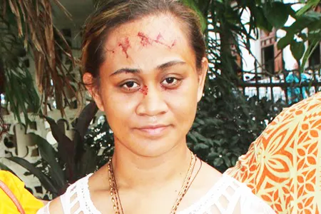 Toaipuapuagā Opapo-Ah Chong shows the signs of “stigmata” 